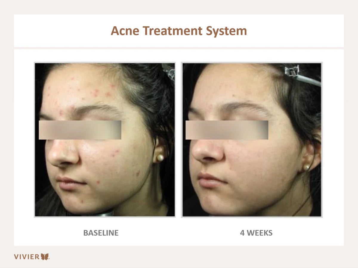 Acne Treatment System