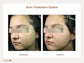 Acne Treatment System