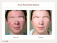 Acne Treatment System
